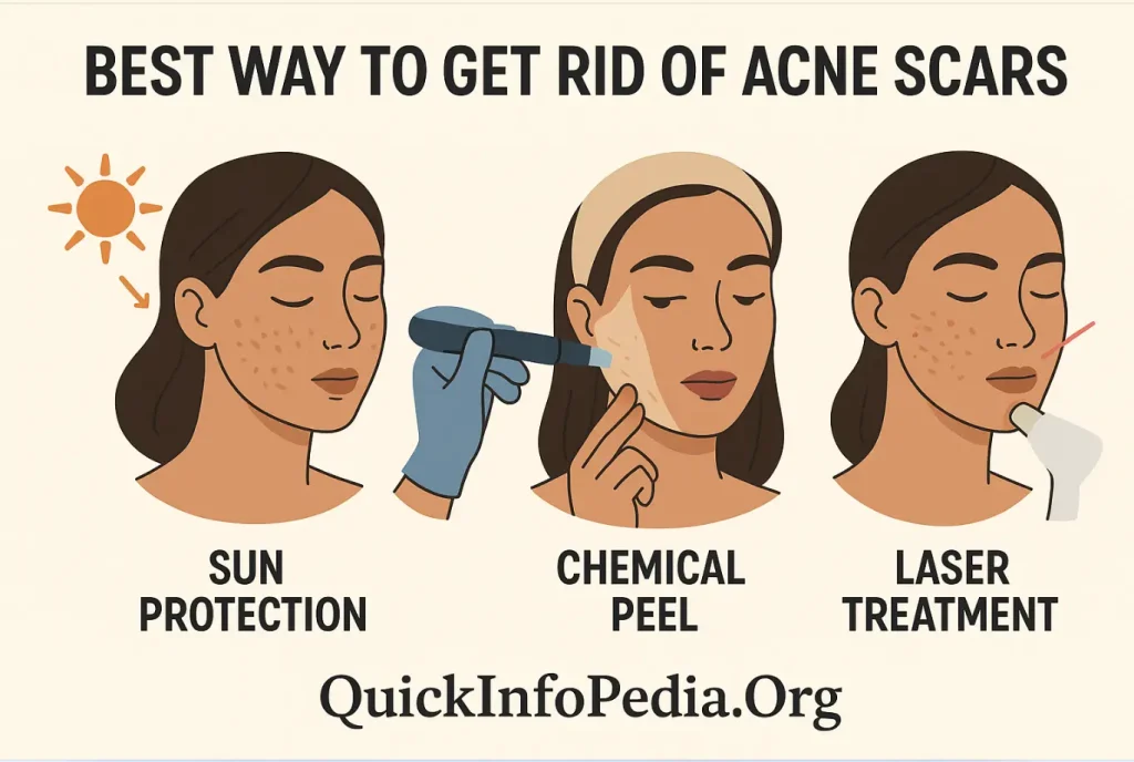natural remedies for acne scars